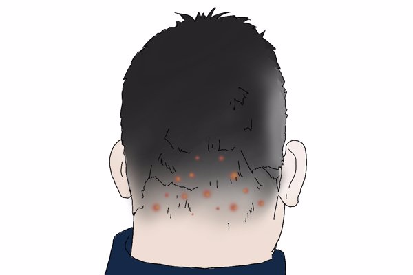 毛囊炎是怎么引起的