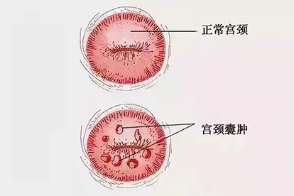 宫颈纳氏囊肿图片