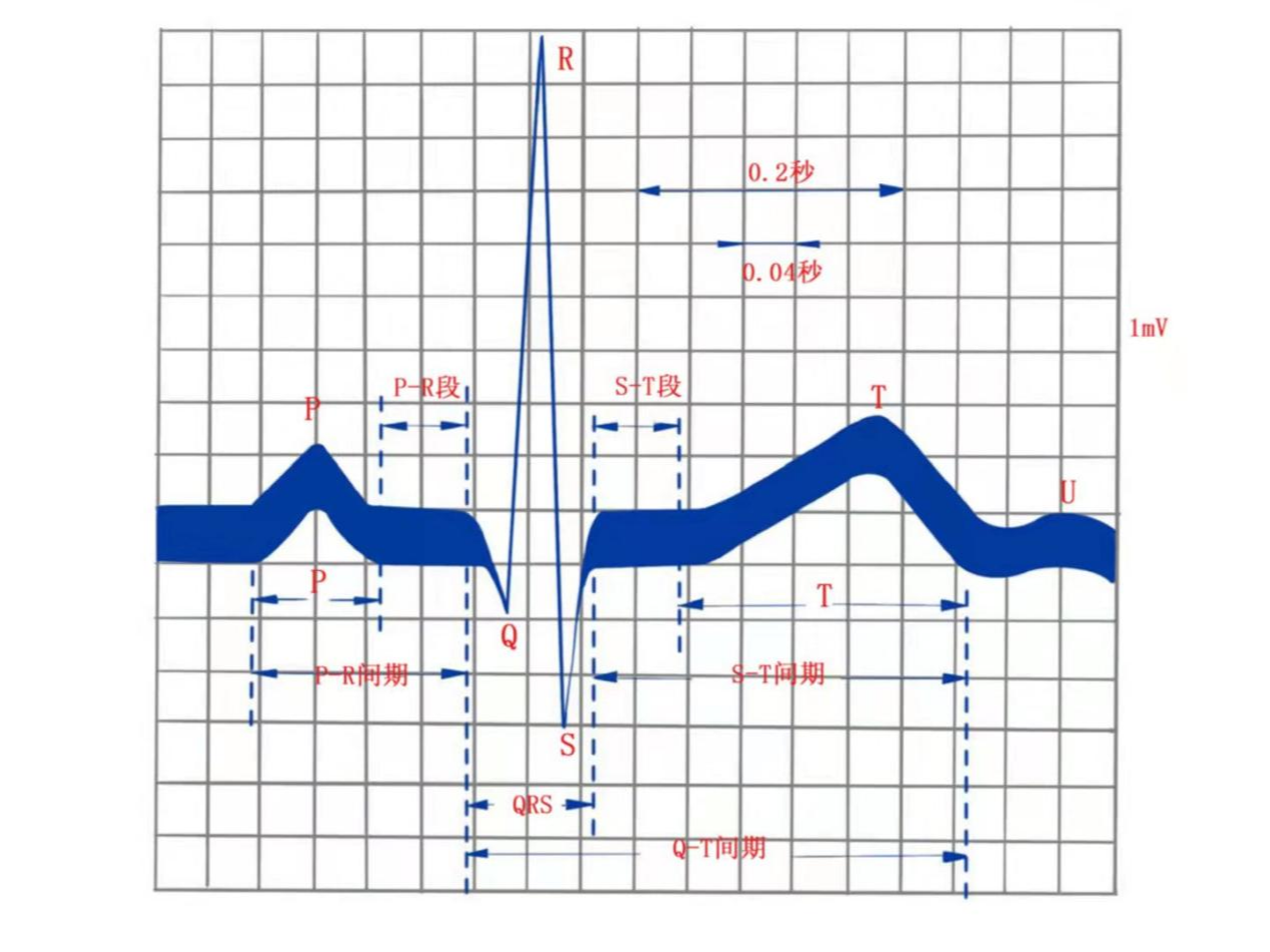 正常心电图