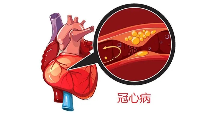 冠心病的症状表现在哪些方面