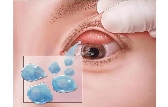 沙眼会不会传染？沙眼和结膜炎怎么辨别？