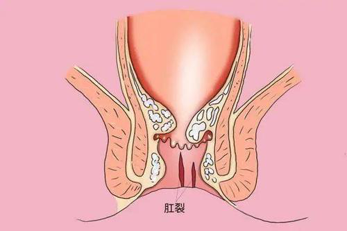 贵阳东大肛肠医院：肛门“裂开”了！可以不治疗吗？医生：诱发肛窦炎、肛瘘，就麻烦了！