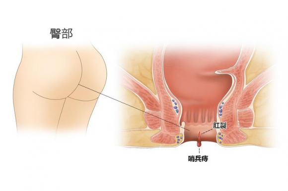 贵阳东大肛肠医院：肛门“裂开”了！可以不治疗吗？医生：诱发肛窦炎、肛瘘，就麻烦了！