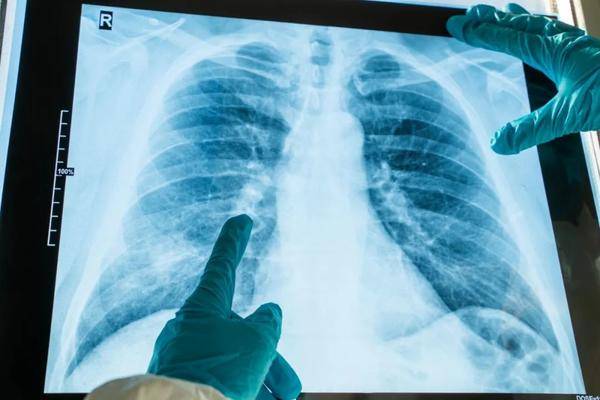 被忽视的肺癌警报：为何90%高危人群错过黄金筛查期？