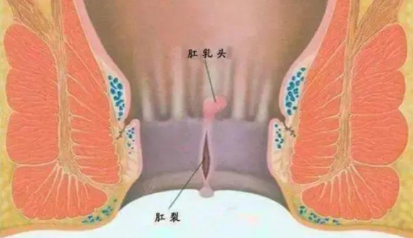 贵阳东大肛肠医院：肛门“裂开”了！可以不治疗吗？医生：诱发肛窦炎、肛瘘，就麻烦了！