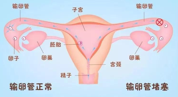 成都西南不孕不育二级医院打通输卵管顺畅之路，让您顺利抱娃