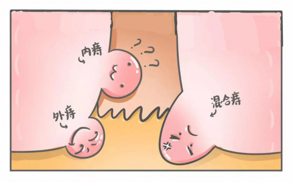 呼和浩特东大肛肠医院：长痔疮了要做手术吗?