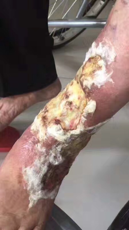 下肢动脉硬化手术多少钱