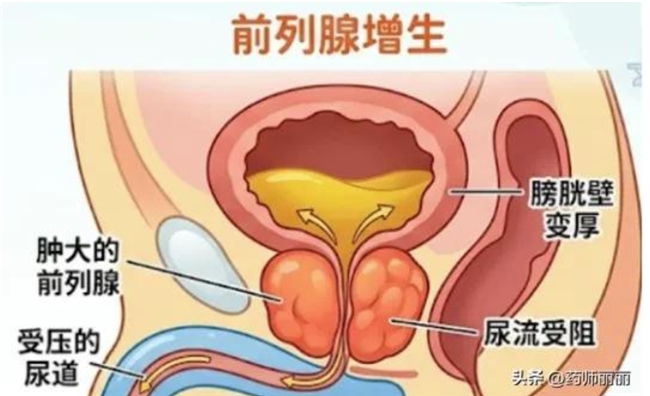夜尿多、排尿无力?科学应对前列腺增生, 一文读懂中西医联合用药