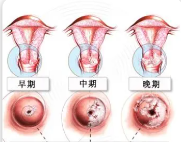 宫颈癌有6个前兆